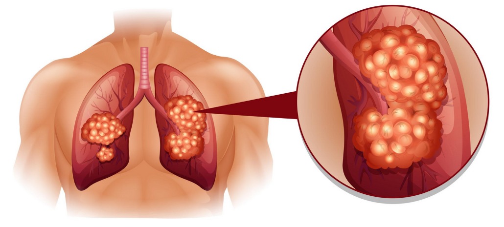 Most Asked Questions About Lung Cancer