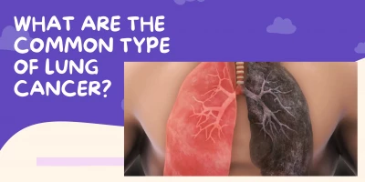 What-Are-The-Common-Type-Of-Lung-Cancer-3