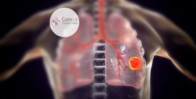 treatment-for-lung-cancer-in-Noida