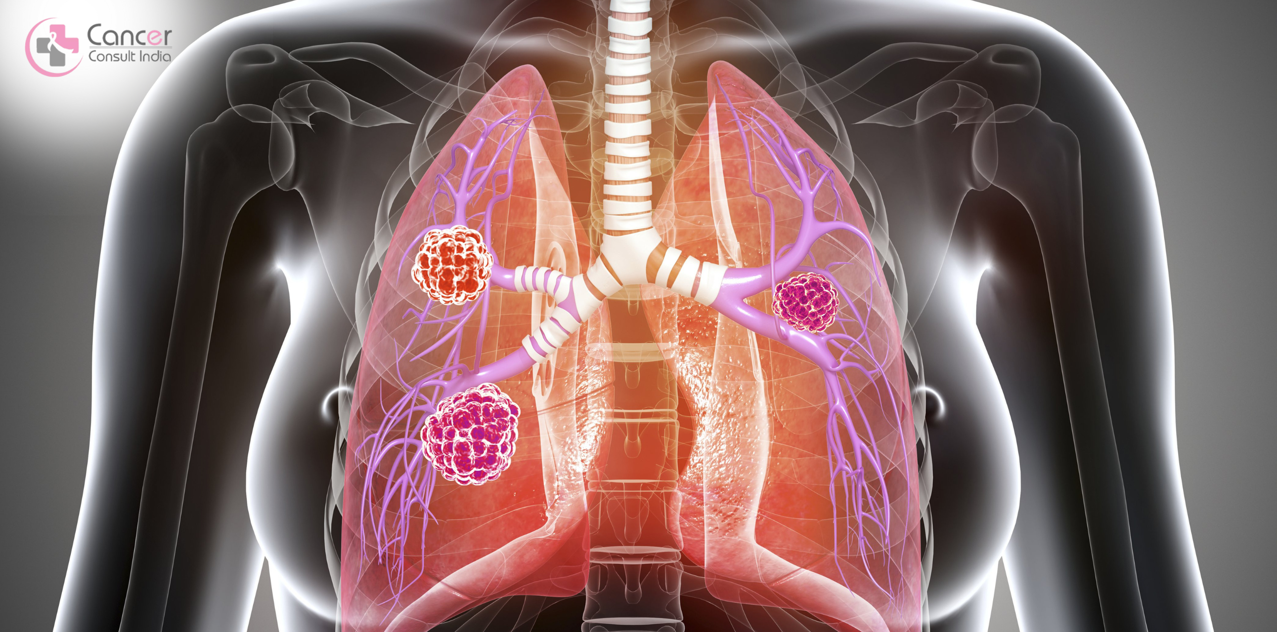 WHAT ARE THE INITIAL SYMPTOMS OF LUNG CANCER | DR. MANISH SINGHAL