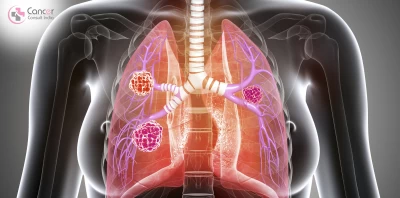 lung cancer doctor in Noida.22222png
