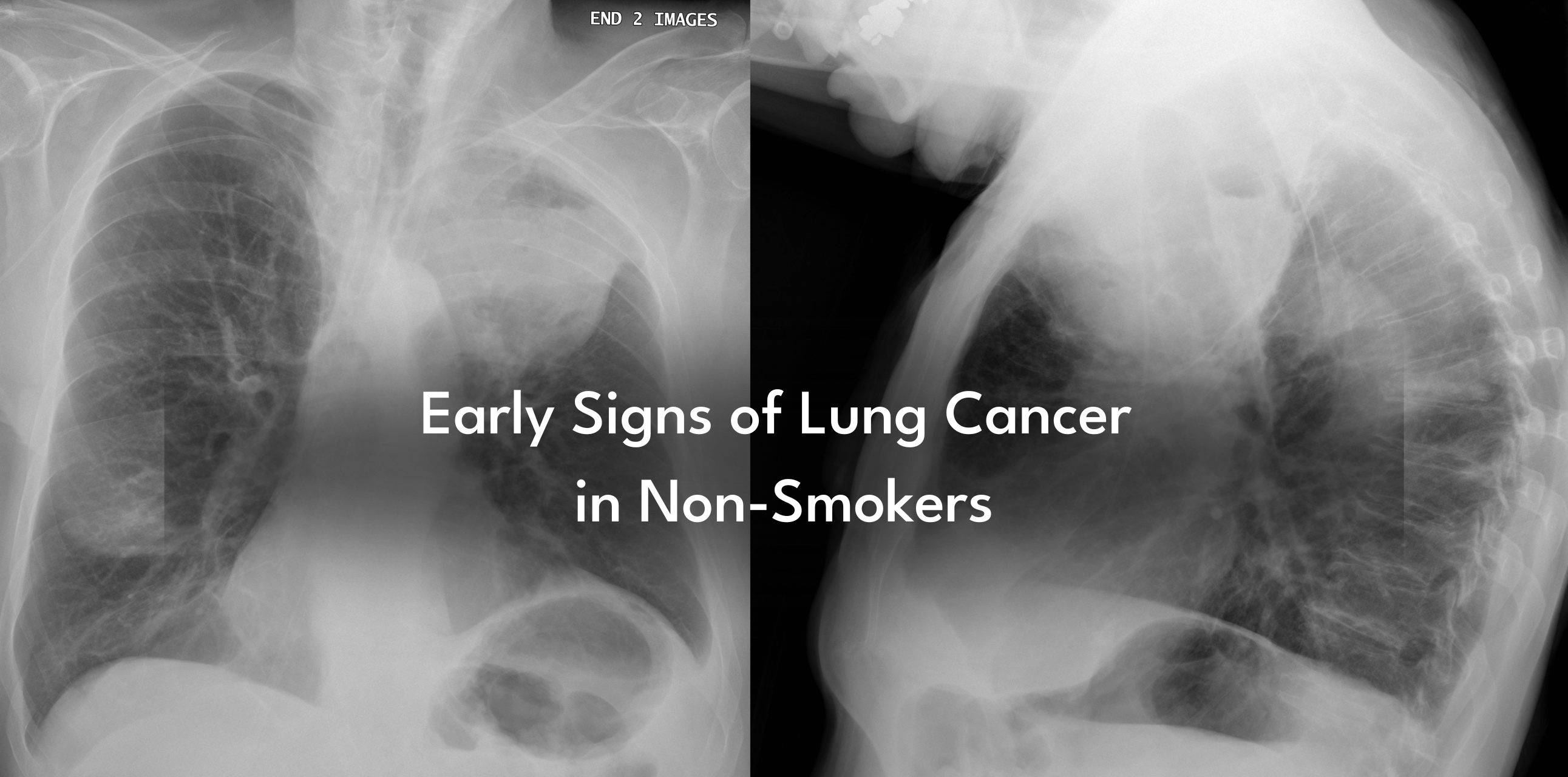 Early Signs of Lung Cancer in Non-Smokers: What to Watch For