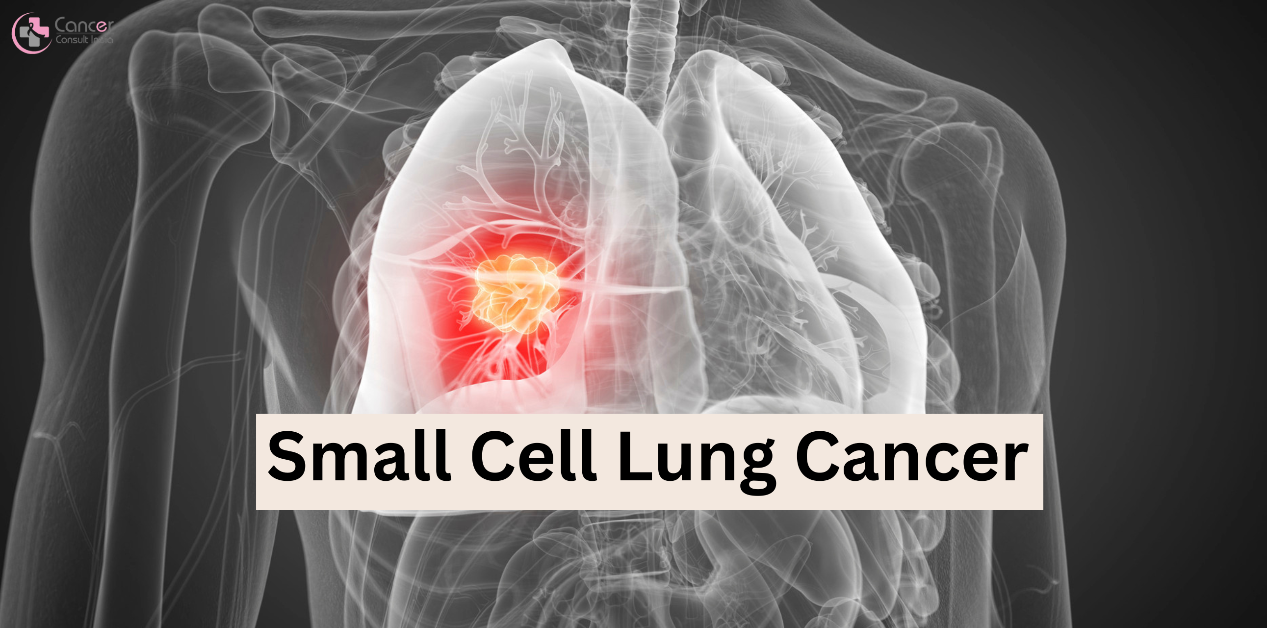 Small Cell Lung Cancer: Effective Treatment Strategies for Patients