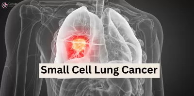 lung cancer doctor in Noida