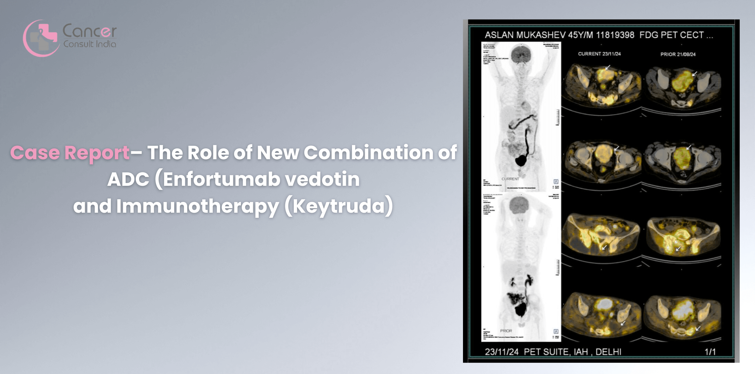 Case Report – The Role of New Combination of ADC (Enfortumab vedotin and Immunotherapy (Keytruda)