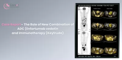 Case Report– The Role of New Combination of ADC (Enfortumab vedotin and Immunotherapy (Keytruda)