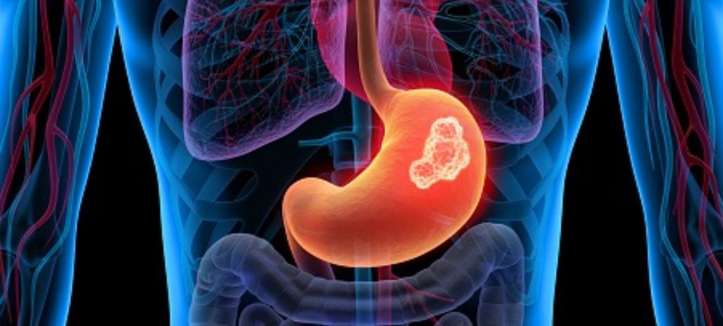 New Approach Against Stomach Cancer: Personalized Drug Prescription