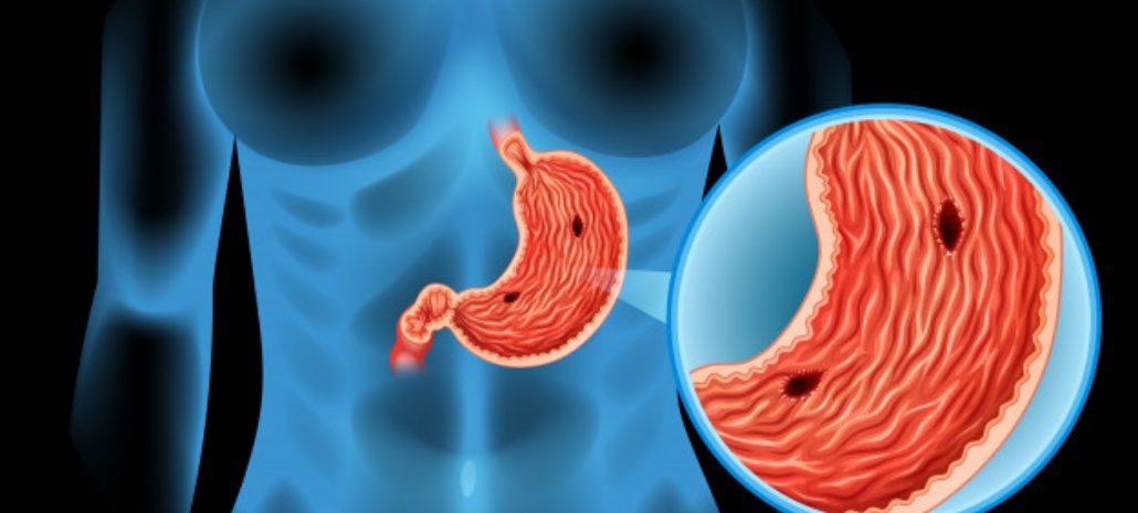 7 Warning Signs of Stomach Cancer that Shouldn't be Ignored
