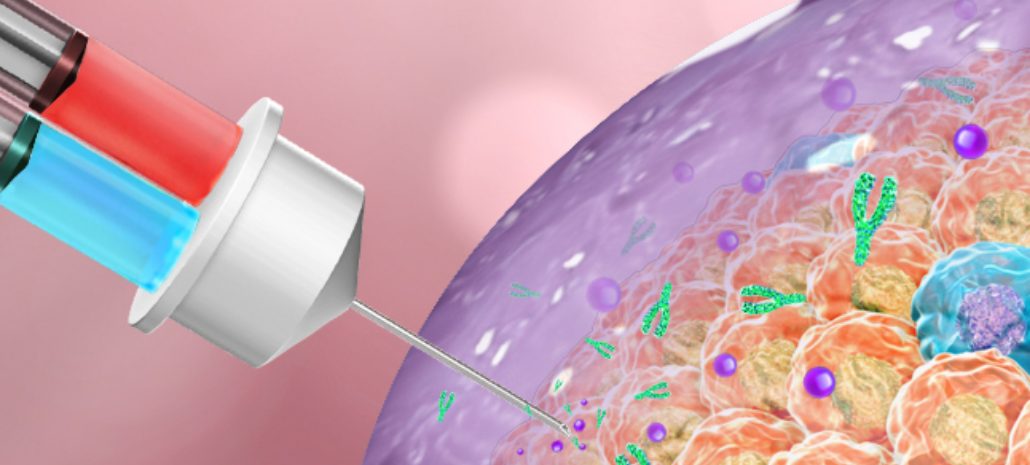 Latest Breast Cancer Therapy That Promise to Destroy Tumor Inside the Body