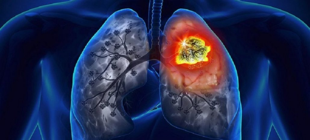 What Is The Most Effective Treatment For Lung Cancer?