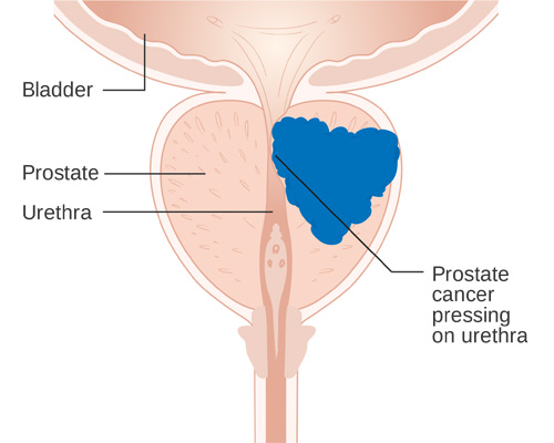 Prostate Cancer Treatment in Delhi