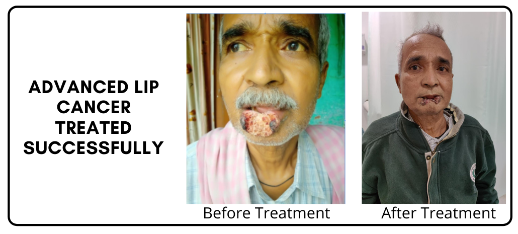 lip-cancer-case-study