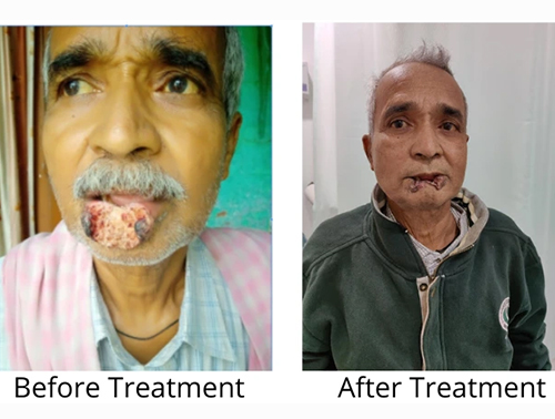 Cancer case studies in India
