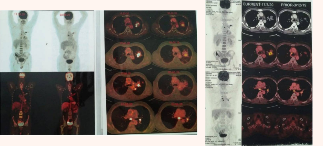 Lung cancer new case study